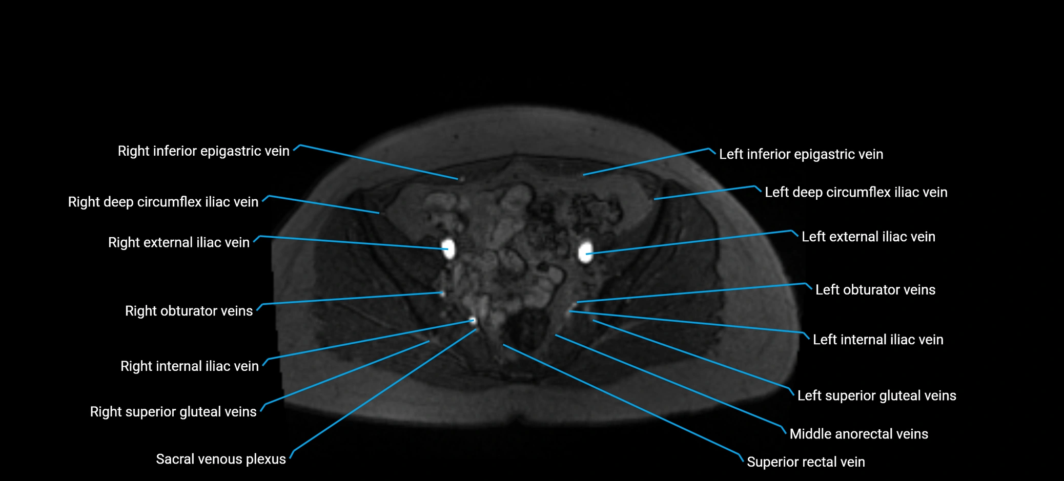 MRV abdomen pelvis & lower limb axial cross sectional anatomy labelled MRI image 151 (1).webp